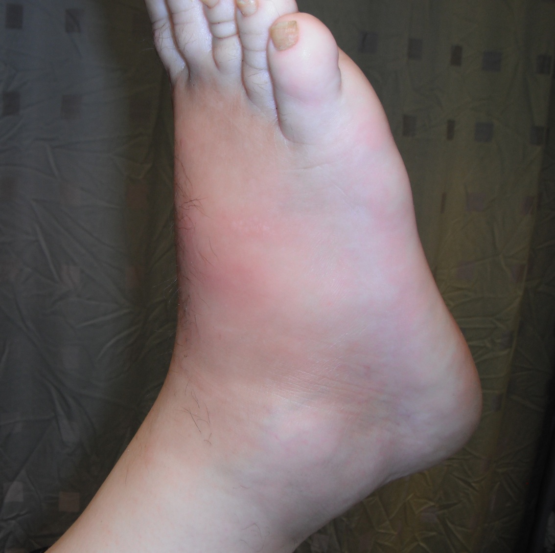 Charcot Foot Elevated